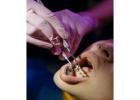 Know the Cost of Orthodontic Retainers – Book a Consultation Today