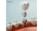 Dental Implant Manufacturers in Mexico for Globally Supply