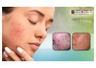 Best Deep Acne Scars Treatment in Bangalore