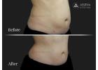 Best Tummy Tuck Surgeon in Delhi | Safe & Natural Tummy Tuck Surgery in Delhi