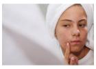 Say Goodbye to Acne Scars – Effective Acne Scar Treatment in Kolkata at Image Clinic