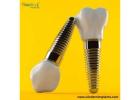 Best Dental Implant Brands in Peru for Lasting Smiles