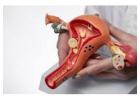 Best Fibroid Treatment in 2025 by Dr. Deepti Asthana