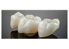 Find minimally invasive Veneers in Tijuana with ultra-thin custom-made shells 
