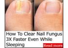 Want To Clear Fungus 3X Faster!? Try THIS Odd Technique