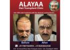 Transform Your Look Best Hair Transplant Clinic in Chandigarh