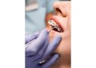 Braces Duration: Typical Timelines KSA