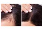 Best Hair Treatment Clinic in Thane | Restore Healthy Hair at DNA Royal Aesthetic Clinic