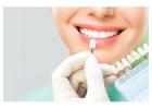 dental veneers in Bangalore | Amayadental