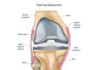 Regain Mobility with Total Knee Replacement Surgery