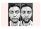 What Are Rhinoplasty Grafts and Why Are They Important?