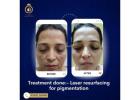 DNA Royal Aesthetic Clinic: Trusted for Laser Resurfacing Treatment in Thane.