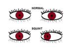 Squint Eye Surgery Specialist in Gurgaon