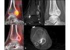 Cryoablation for Osteoblastoma at Picture This Imaging