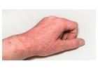 Best Homeopathic Remedies For Eczema - Rise And Shine Medical Centre