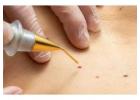  Wart Removal Done Right by Professionals