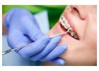 When Do Dentists Recommend Orthodontic Tooth Uncovering?