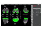 How Can Robotic Partial Knee Replacement Surgery Benefit You?