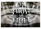 Full Mouth Dental Implants in Mexico with Teeth Savers