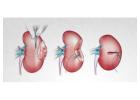 Kidney Cancer Treatments In Bangalore | World of Urology