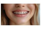 Affordable Braces Singapore – Achieve Your Perfect Smile