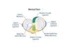 Professional Meniscus Repair Surgery for Effective Pain Relief