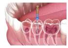 Does Dental Insurance Cover Root Canal? Get Expert Care Here
