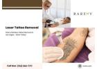 Laser Tattoo Removal: Safe and Effective Way to Clear Your Skin