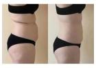 Gentle Fat Freezing Treatment in Windsor