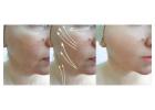 Botox Treatment in Kolkata – Smooth, Youthful & Natural Results