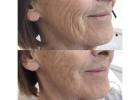 Envy Aesthetics – Best Skin Booster Injections for Radiance and Hydration