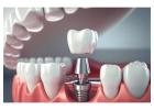  Best Dental Implants Clinic Ahmedabad - Pramukh Dental Care 