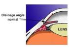 Best Glaucoma Specialist in Gurgaon 