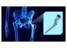 Total Hip Replacement Surgery in Delhi – Advanced Anterior Approach