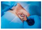 SILK Eye Surgery in India – Advanced Vision Correction