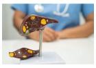 Top Chronic Liver Specialists in Ludhiana for Expert Care  
