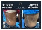 Side Effect-Free Vitiligo Treatment – Laxmi Vitiligo Centre