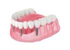 emergency dental implants — 24/7 Urgent Appointments