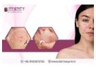 Acne Scar Treatment in Bangalore at Dermaqure