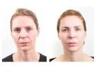 Experience a Non-Surgical Facelift in Arlington TX at The Revive You Clinic Experts"