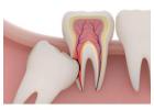Root Canal Treatment Canberra