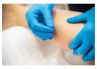Trusted Acupuncture Services to Enhance Your Wellness