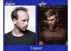 Restore Your Confidence with Professional Hairline Replacement | worldhairinstitute