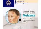 The top melasma treatment in Thane is offered by DNA Royal Aesthetic Clinic.