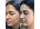 Top Acne Treatment in Thane by DNA Royal Aesthetic Clinic.