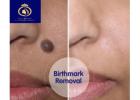 In Thane, DNA Royal Aesthetic Clinic provides Best laser birthmark removal treatment.