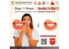 Top Dental Implants Hospital in Nellore | FREE Consultation 