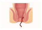 Trusted Lady Doctor for Piles Providing Advanced Treatment Options
