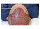 Thane’s Premier Hair Transplant Specialists – DNA Royal Aesthetic Clinic.