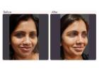 Dimple Creation Surgery Cost in Delhi - Dr Rajat Gupta